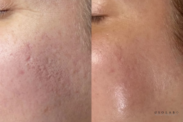 da bị bong tróc sau peel