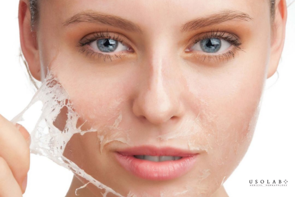 không cạy bong tróc sau peel