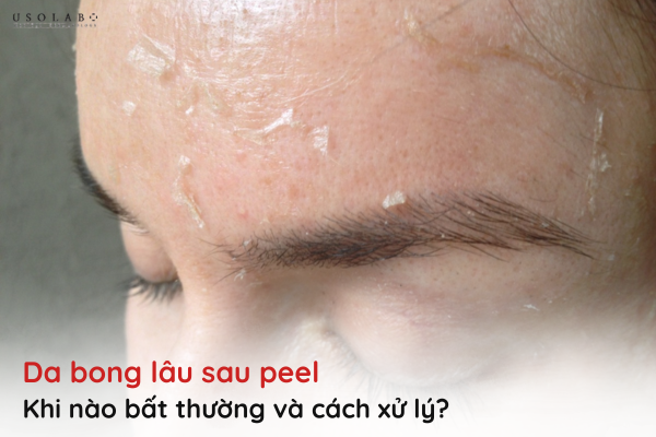 da bong lâu sau peel