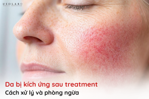 da kích ứng sau treatment