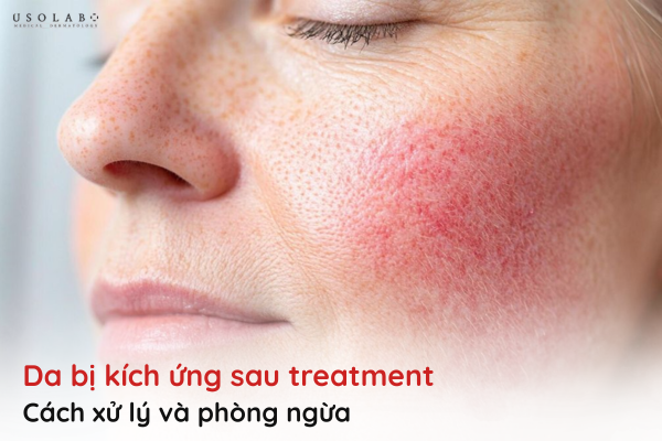 da kích ứng sau treatment