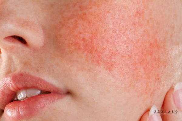 da kích ứng sau treatment
