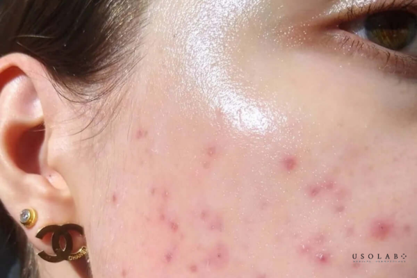 dấu hiệu da đang bị kích ứng