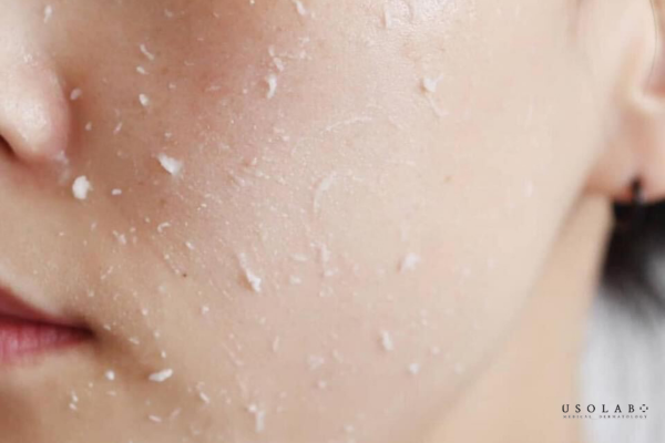 làm sạch da sau treatment