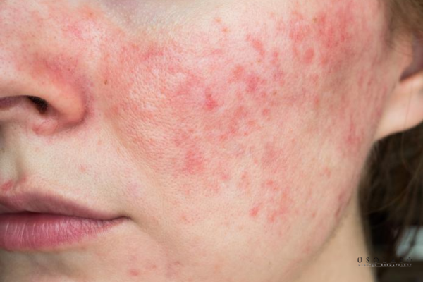 da yếu sau treatment