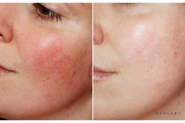 da yếu sau treatment