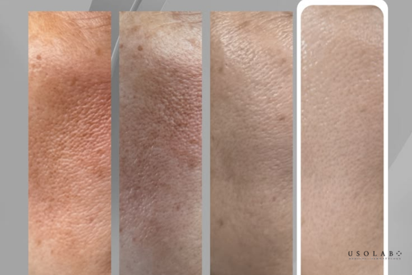 quy trình chăm sóc da yếu sau treatment