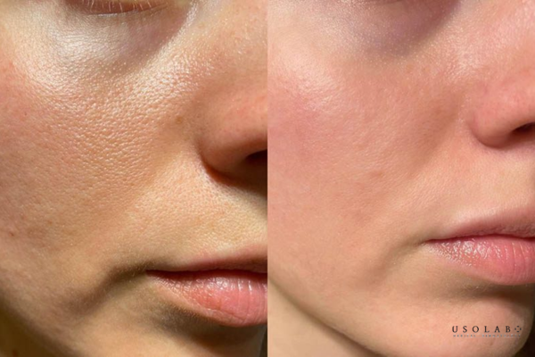 da yếu sau treatment