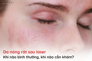 da nóng rát sau laser