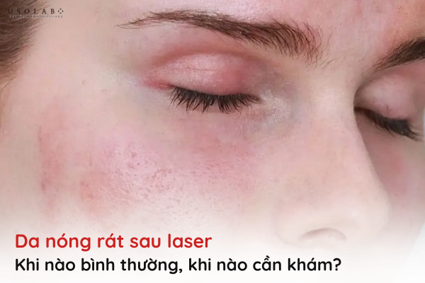 da nóng rát sau laser