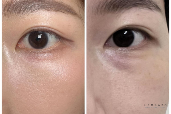 kem trị thâm quầng mắt