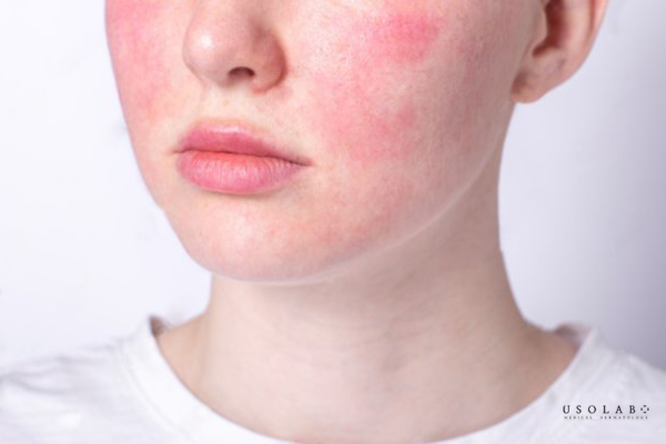 routine phục hồi da sau treatment