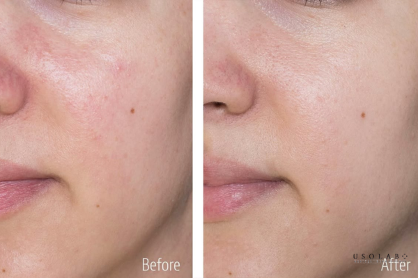 routine phục hồi da sau treatment
