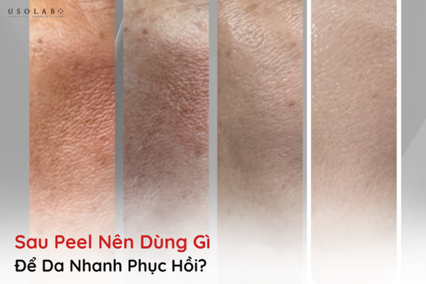 sau peel nên dùng gì
