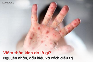 viêm thần kinh da