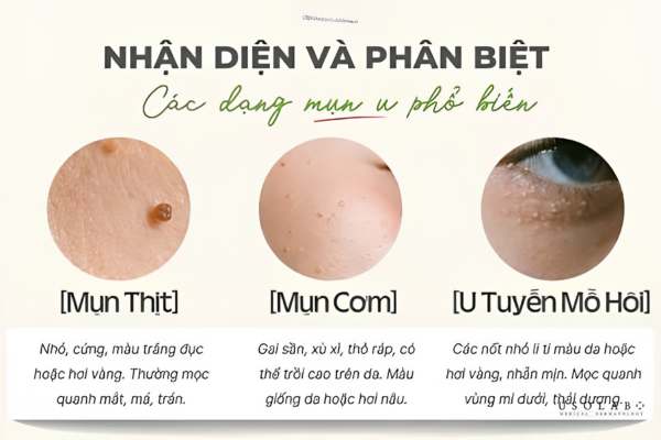 kem trị mụn thịt quanh mắt nhật bản