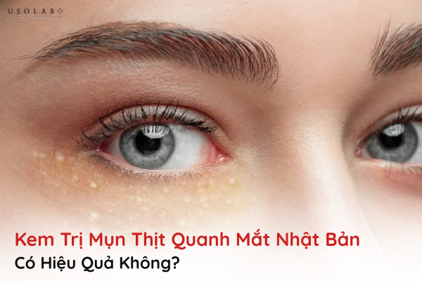 kem trị mụn thịt quanh mắt nhật bản