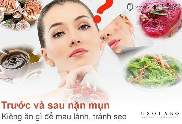 Trước và sau nặn mụn kiêng ăn gì để mau lành, tránh sẹo thâm? 