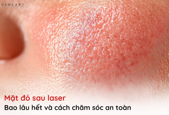 mặt đỏ sau laser