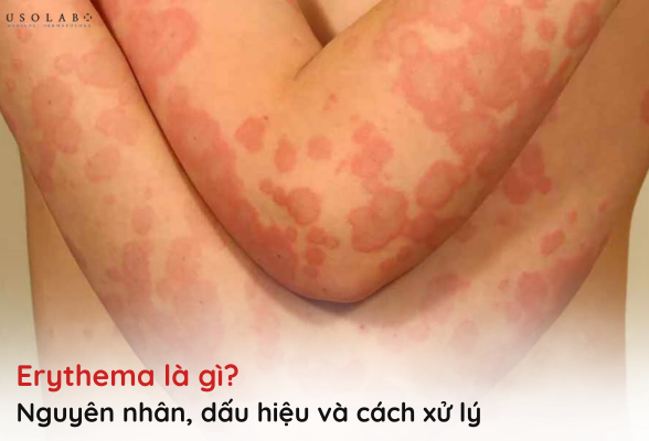 erythema là gì