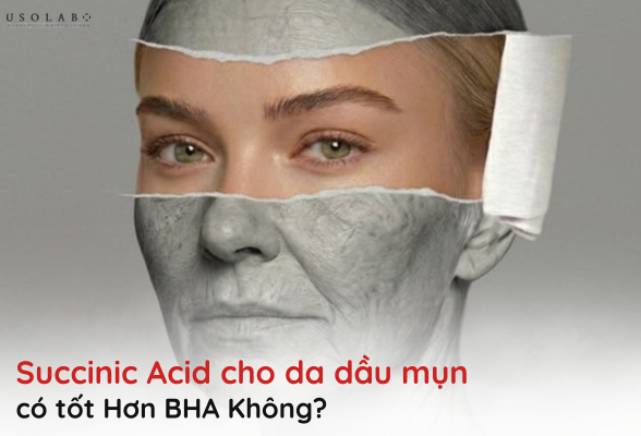 succinic acid cho da dầu