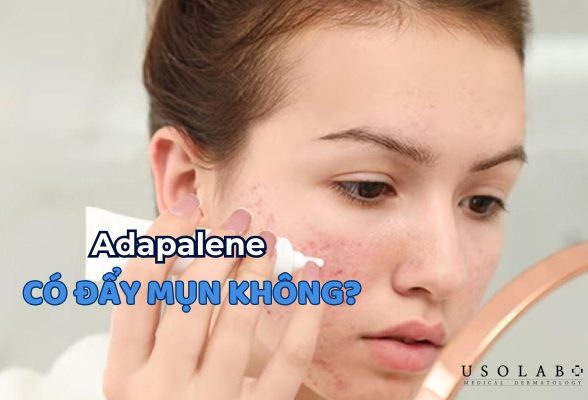 adapalene có đẩy mụn không