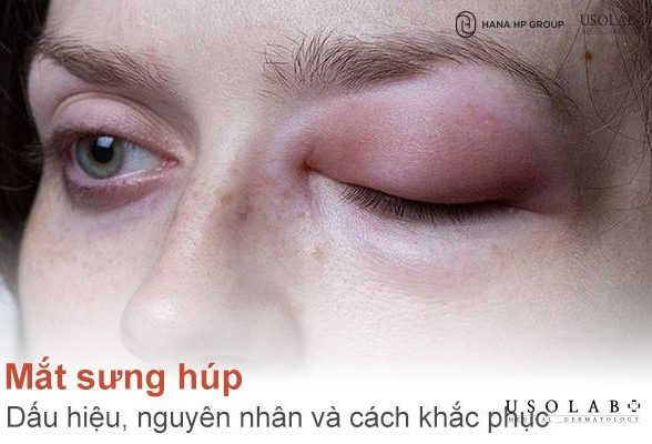 Mắt sưng húp - Dấu hiệu, nguyên nhân và cách khắc phục tại nhà