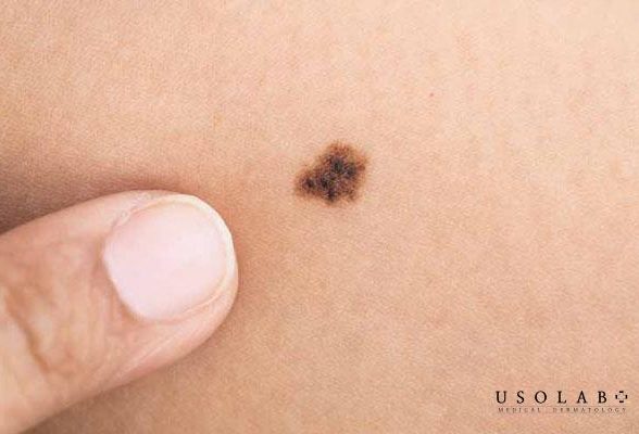 Mụn đầu đen có thành nốt ruồi không? Cách phân biệt và xử lý