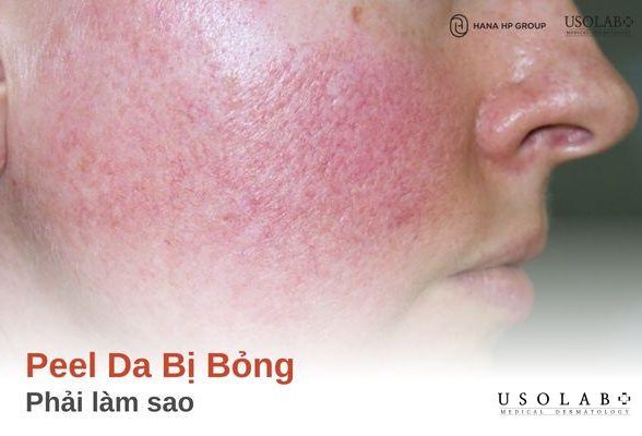 Peel da bị bỏng phải làm sao? Cách xử lý và phòng ngừa hiệu quả