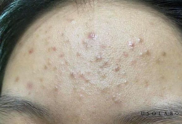 Quá trình đẩy mụn diễn ra trong bao lâu? Cách kiểm soát