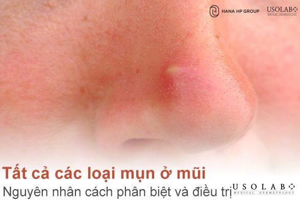 Tất cả các loại mụn ở mũi - Nguyên nhân cách phân biệt và điều trị