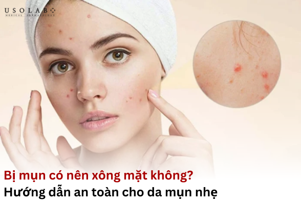 bị mụn có nên xông mặt không