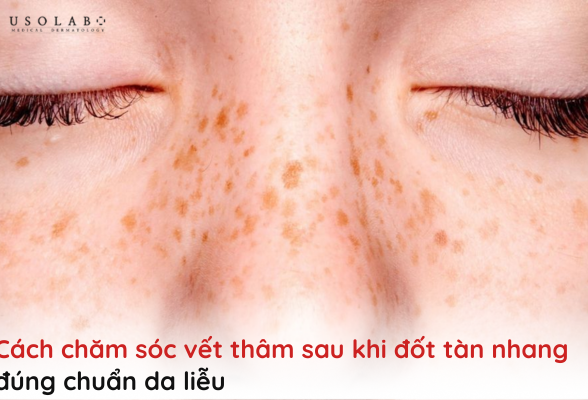 cách chăm sóc vết thâm sau khi đốt tàn nhang