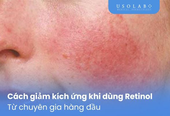 Cách giảm kích ứng khi dùng Retinol