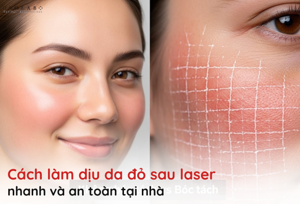 cách làm dịu da đỏ sau laser