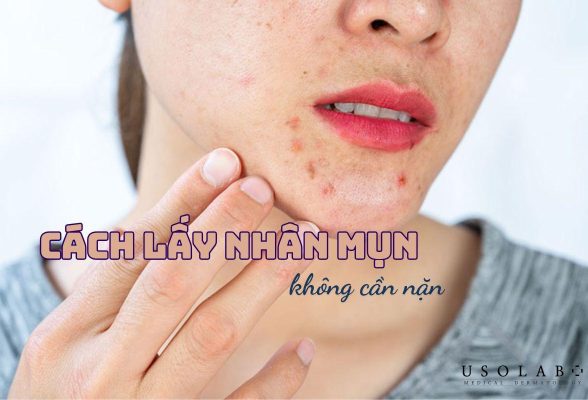 cách lấy nhân mụn không cần nặn