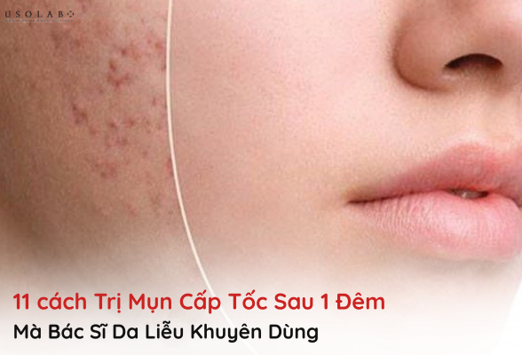 trị mụn cấp tốc sau 1 đêm