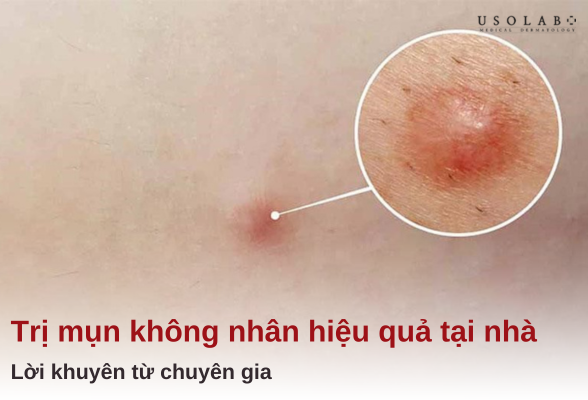 cách trị mụn không nhân