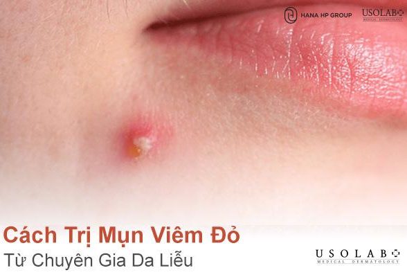 6 Cách Trị Mụn Viêm Đỏ từ Chuyên Gia Da Liễu không lo tái phát