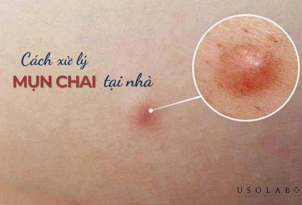 cách xử lý mụn chai tại nhà