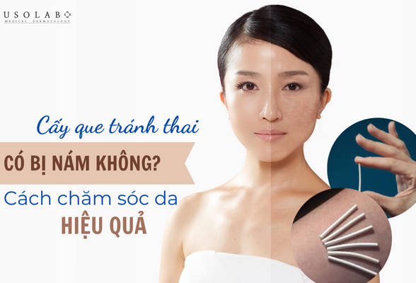 Cấy que tránh thai có bị nám da không