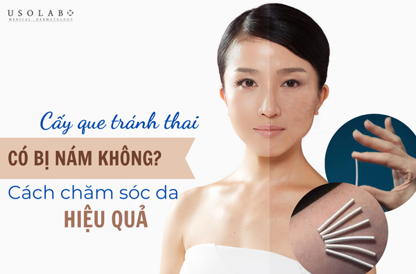 Cấy que tránh thai có bị nám da không