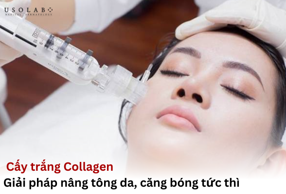 cấy trắng collagen