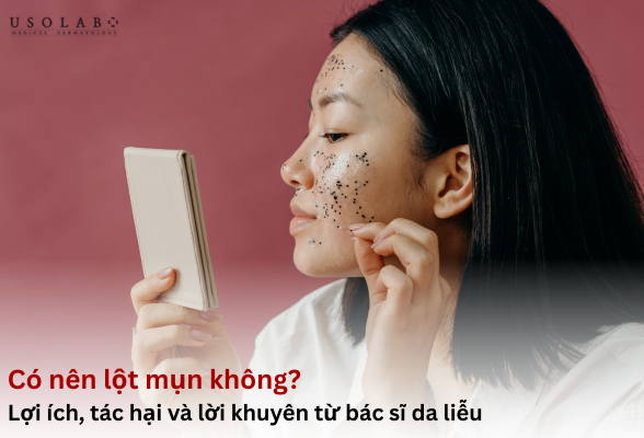 có nên lột mụn không