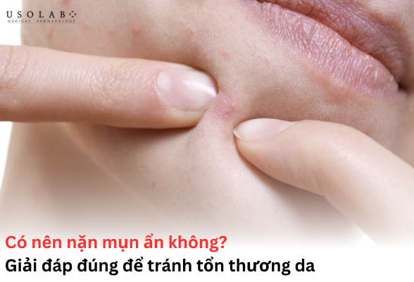 có nên nặn mụn ẩn không