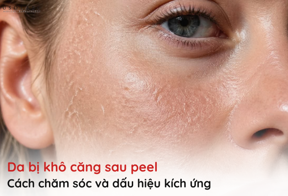 da bị khô căng sau peel