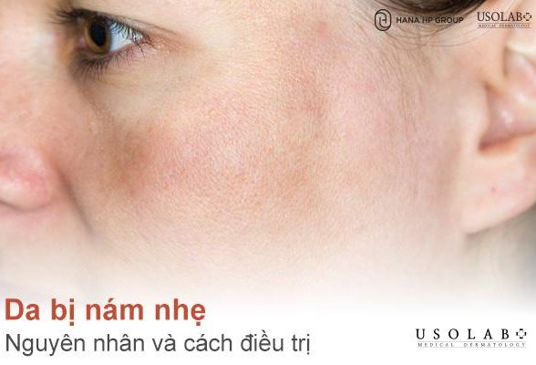 Da bị nám nhẹ có tự hết không? Nguyên nhân và cách điều trị