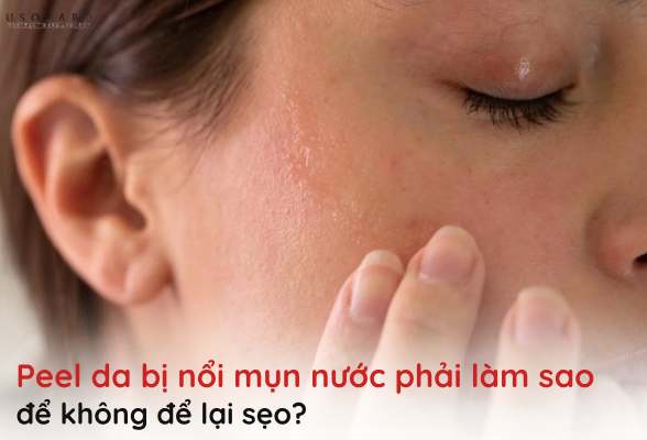 peel da bị nổi mụn nước