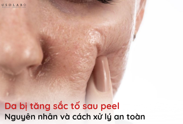 da bị tăng sắc tố sau peel