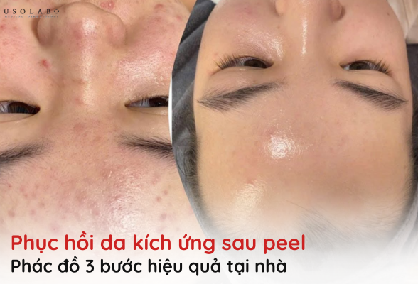 da kích ứng sau peel